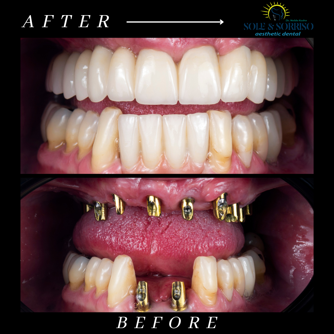 happy client at sole & sorriso dental clinik in tirana