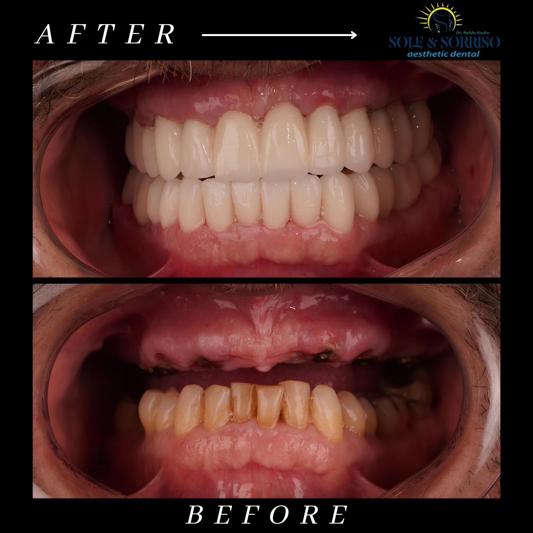 happy client at sole & sorriso dental clinik in tirana