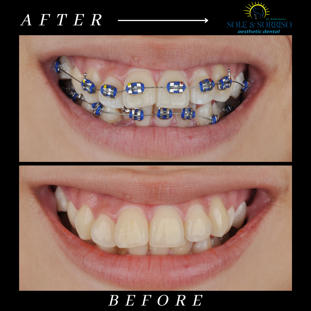 happy client at sole & sorriso dental clinik in tirana