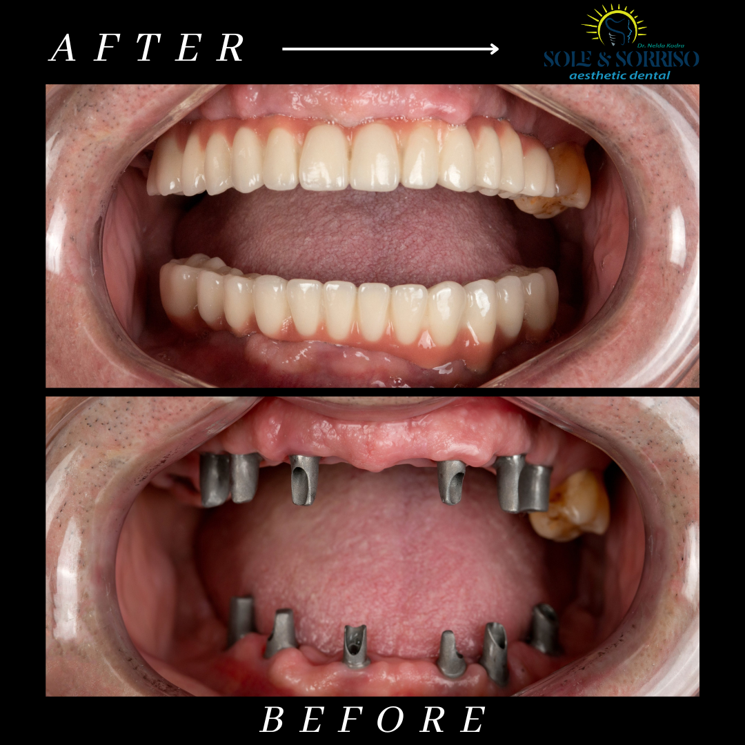 happy client at sole & sorriso dental clinik in tirana