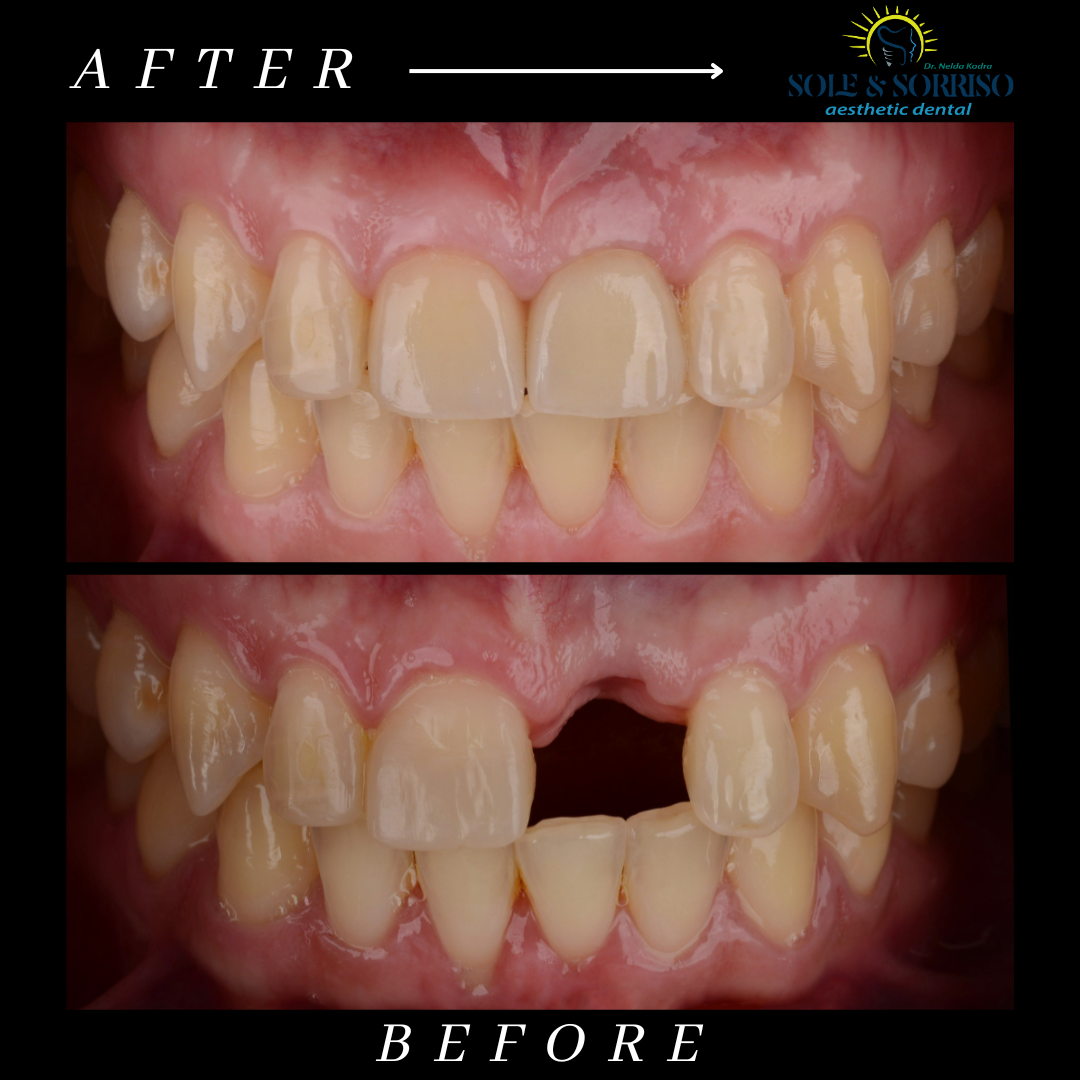 happy client at sole & sorriso dental clinik in tirana