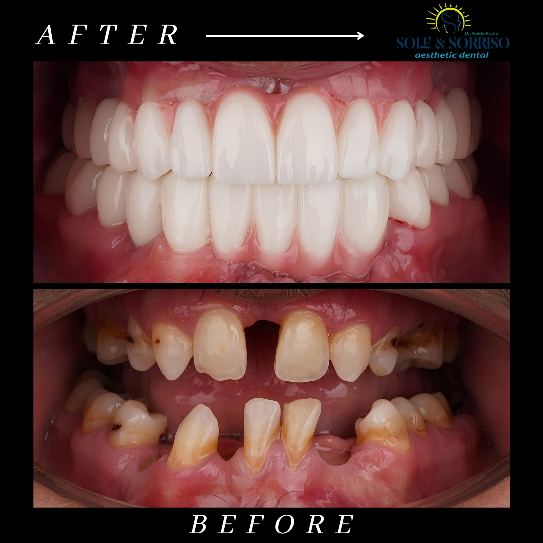 happy client at sole & sorriso dental clinik in tirana