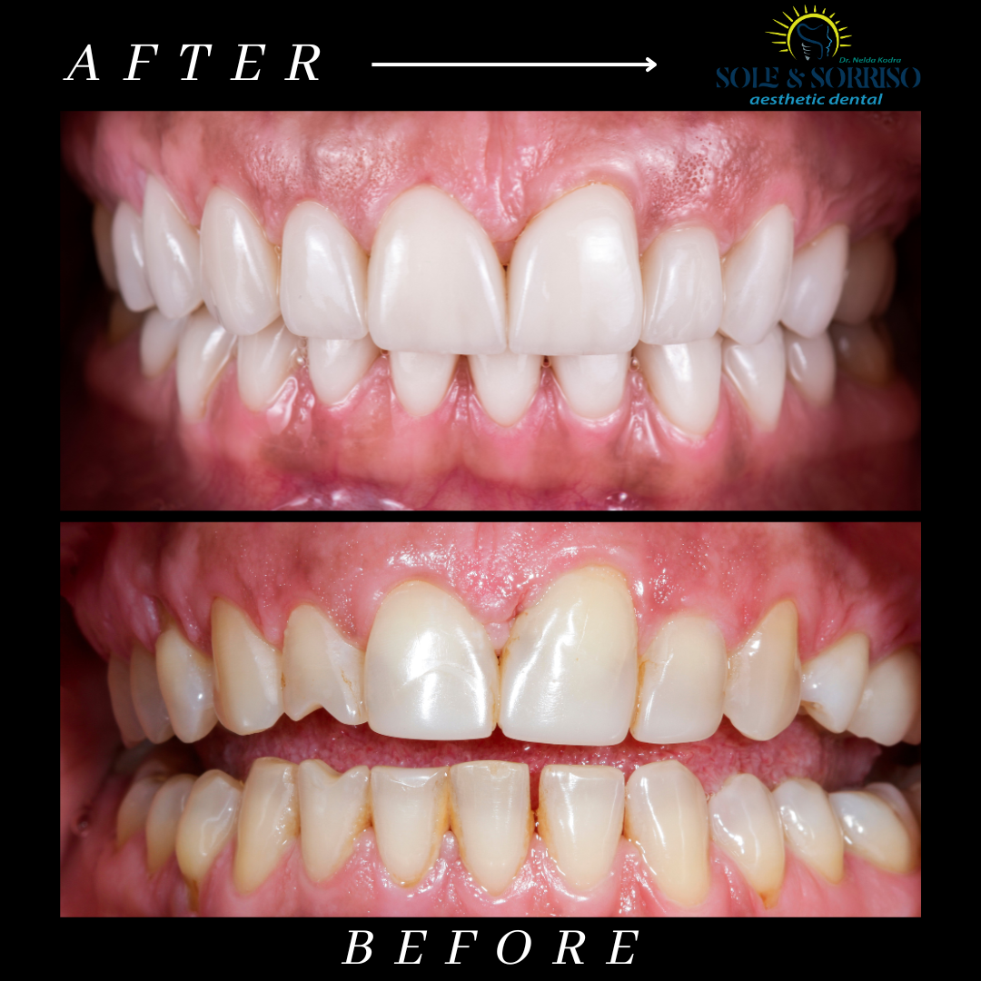 happy client at sole & sorriso dental clinik in tirana