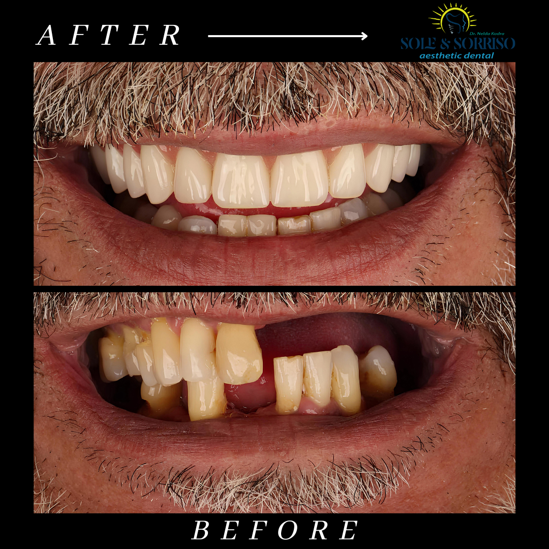 happy client at sole & sorriso dental clinik in tirana