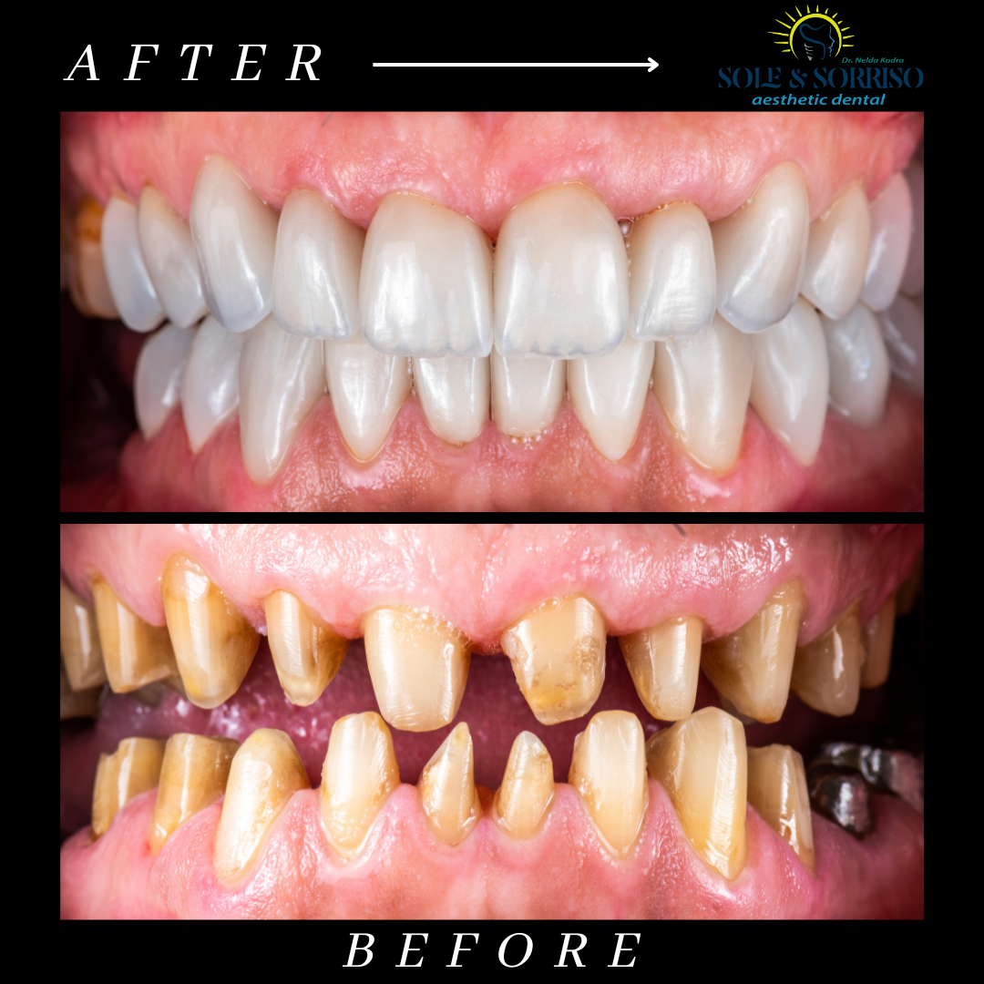 happy client at sole & sorriso dental clinik in tirana