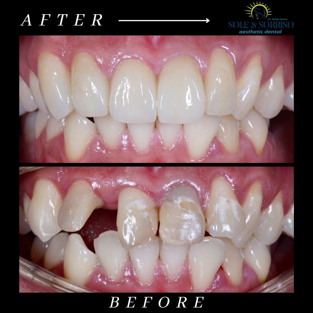 happy client at sole & sorriso dental clinik in tirana